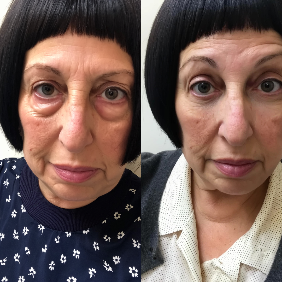 Antes y después del contorno de ojos